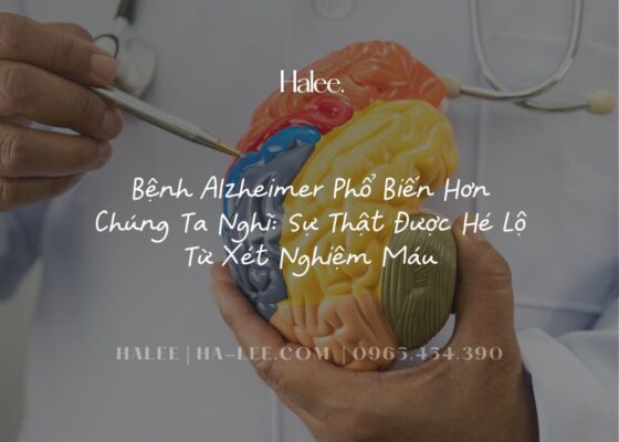 Bệnh Alzheimer Phổ Biến Hơn Chúng Ta Nghĩ Sự Thật Được Hé Lộ Từ Xét Nghiệm Máu